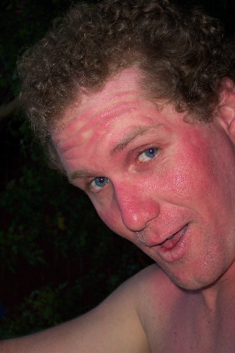 Joshy sunburnt